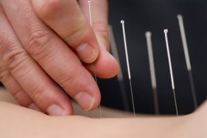 Acupuncture is a component of the health care system of China that can be traced back over 3,000 years. Qi is energy that flows through channels in the body called meridians. As long as there is a free flowing circulation of qi through the meridian system, we are at our optimum health.